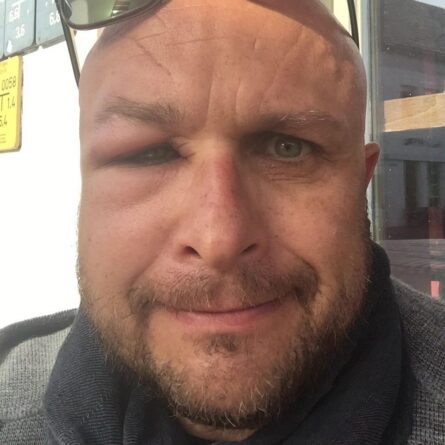 Boris Erdtmann mit einem geschwollenen Auge, da er von einer Biene gestochen wurde